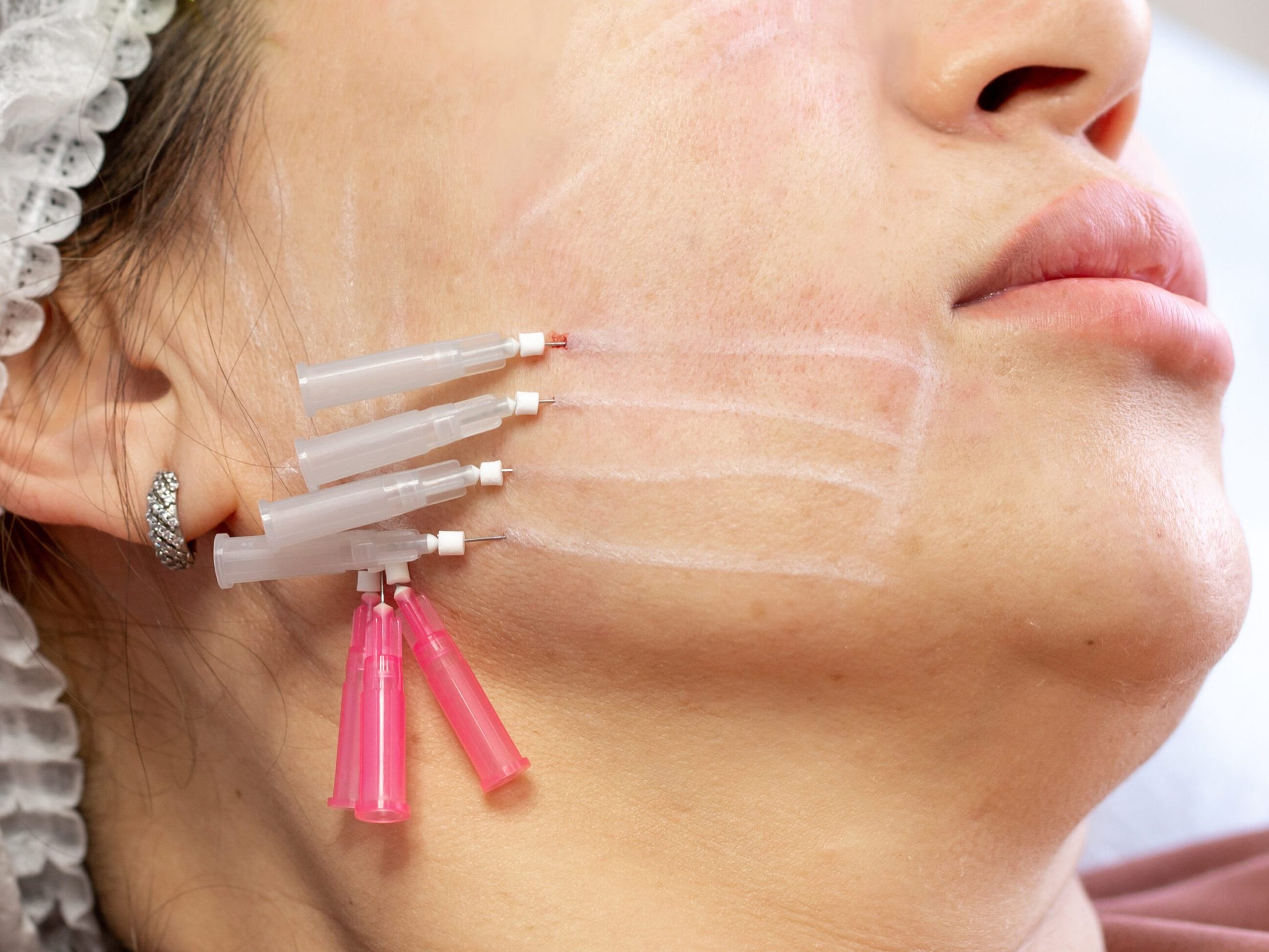 Close-up view of PDO threads, a type of dissolvable suture material commonly employed in non-surgical facelifts and skin rejuvenation treatments.