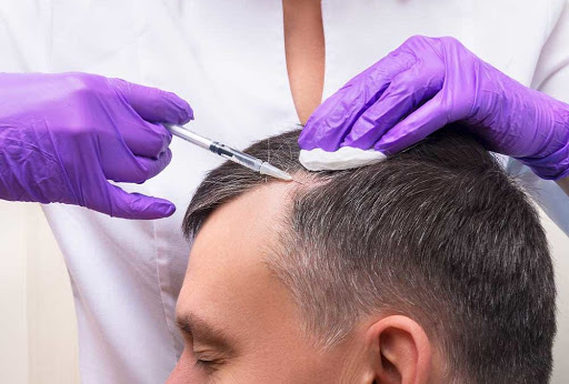 A man receiving exosomes hair therapy from a doctor.