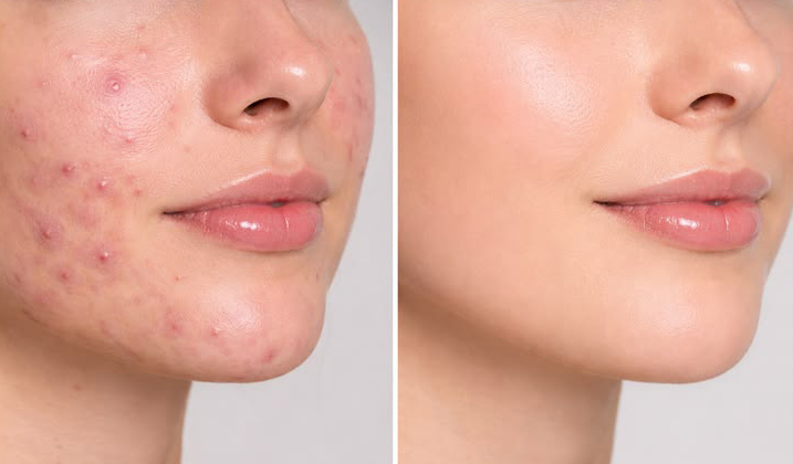 Acne Scar Reduction