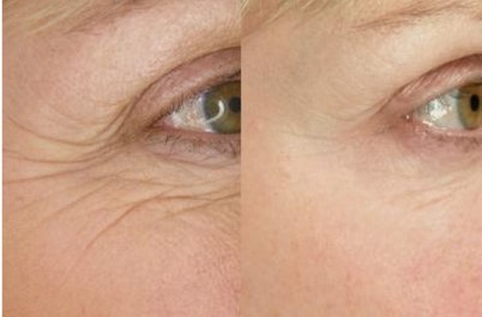 Precision Wrinkle Reduction