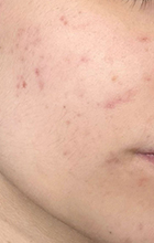 IPL Laser Acne treatment after