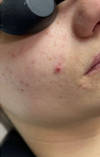 IPL Laser Acne treatment before