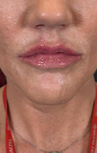 Lip Filler after