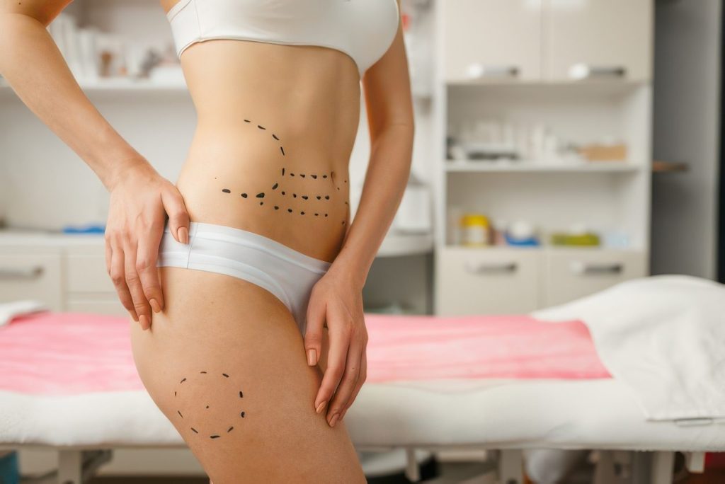 Body contouring treatment area marked on a patient before non-invasive fat reduction