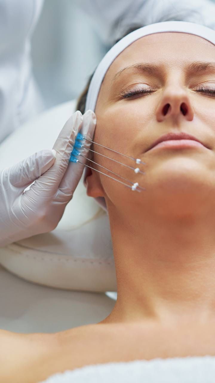 PDO thread lift to lift and tighten facial skin at Mediversity in Turnersville, NJ
